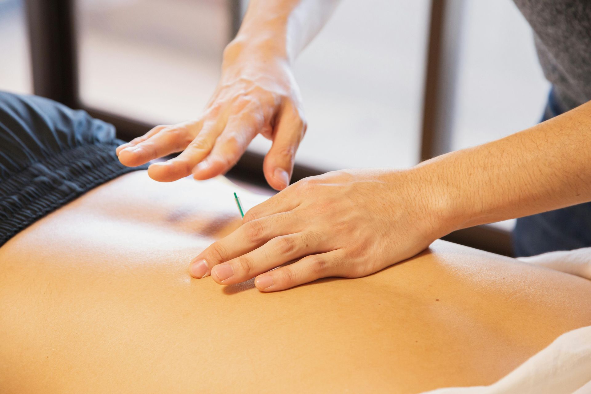Person receiving acupuncture on their back; a needle inserted.