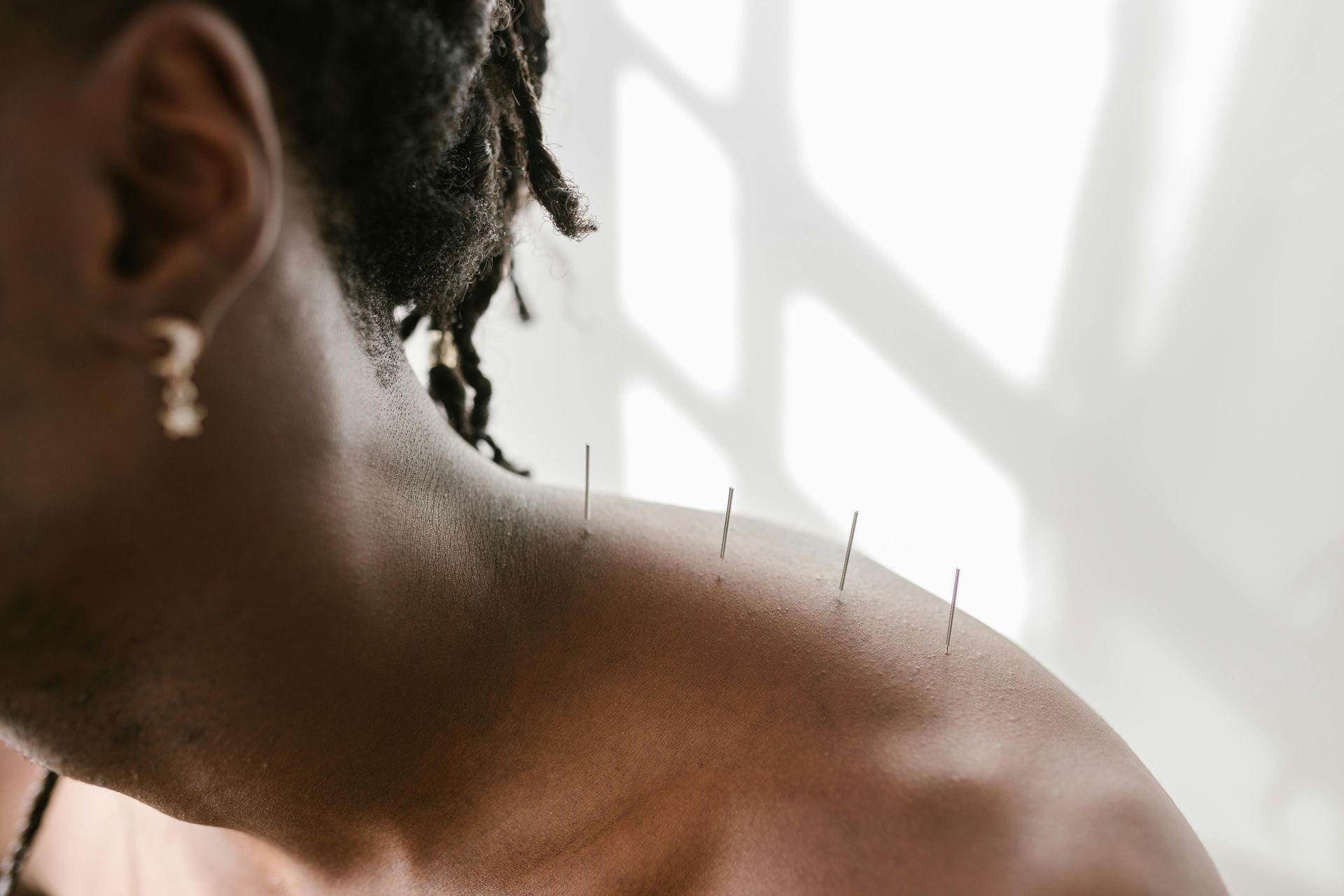 Person's shoulder with acupuncture needles inserted; close-up view near a window, natural light.