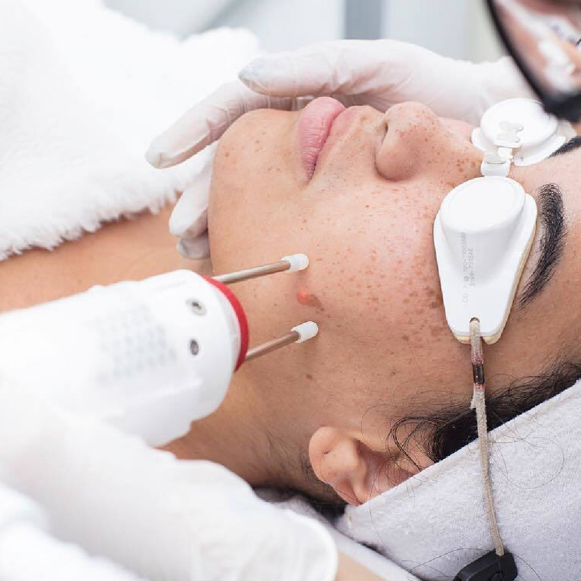 Featuring the Aerolase Laser performing a skin treatment at a medical spa