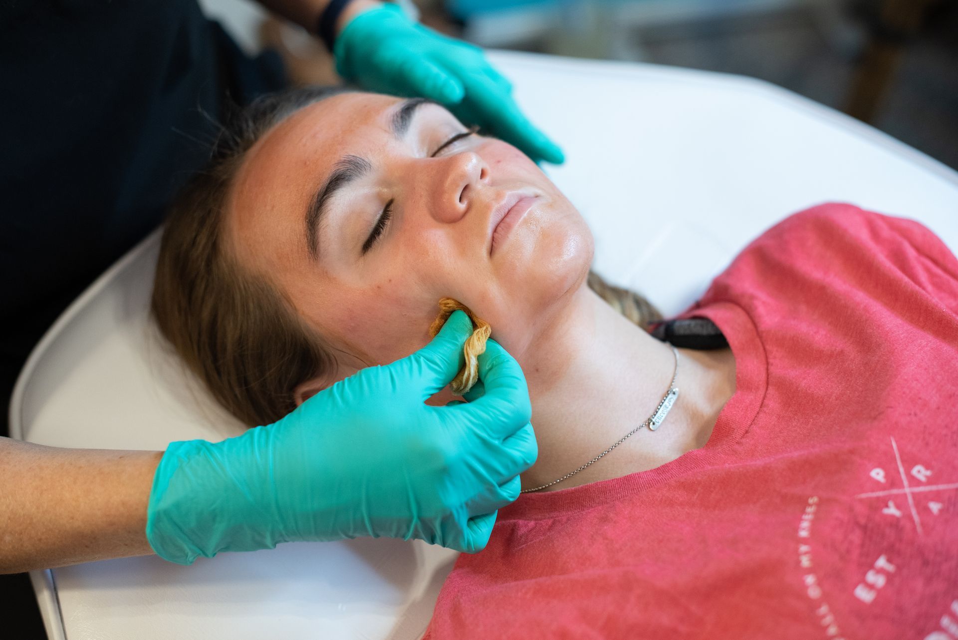 Chemical peel for acne scars in Myrtle Beach
