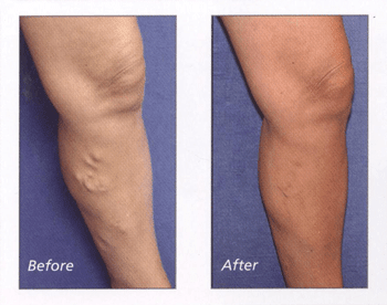 Before and After Desert Heart - Heart specialists in Palm springs, Palm Desert, CA