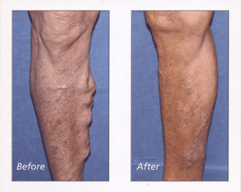 Before and After Desert Heart - Heart specialists in Palm springs, Palm Desert, CA