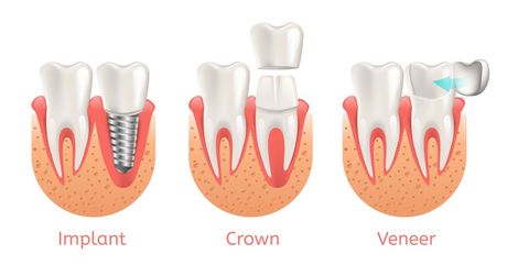 Veneers — Teeth Procedure of Implant Veneer Crown Restoration in Cordova, TN