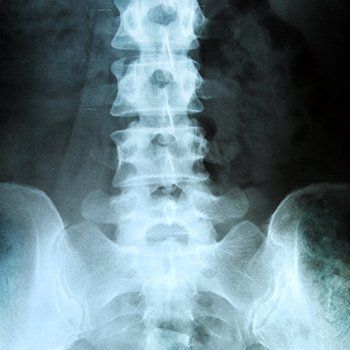 xray of the spinal cord