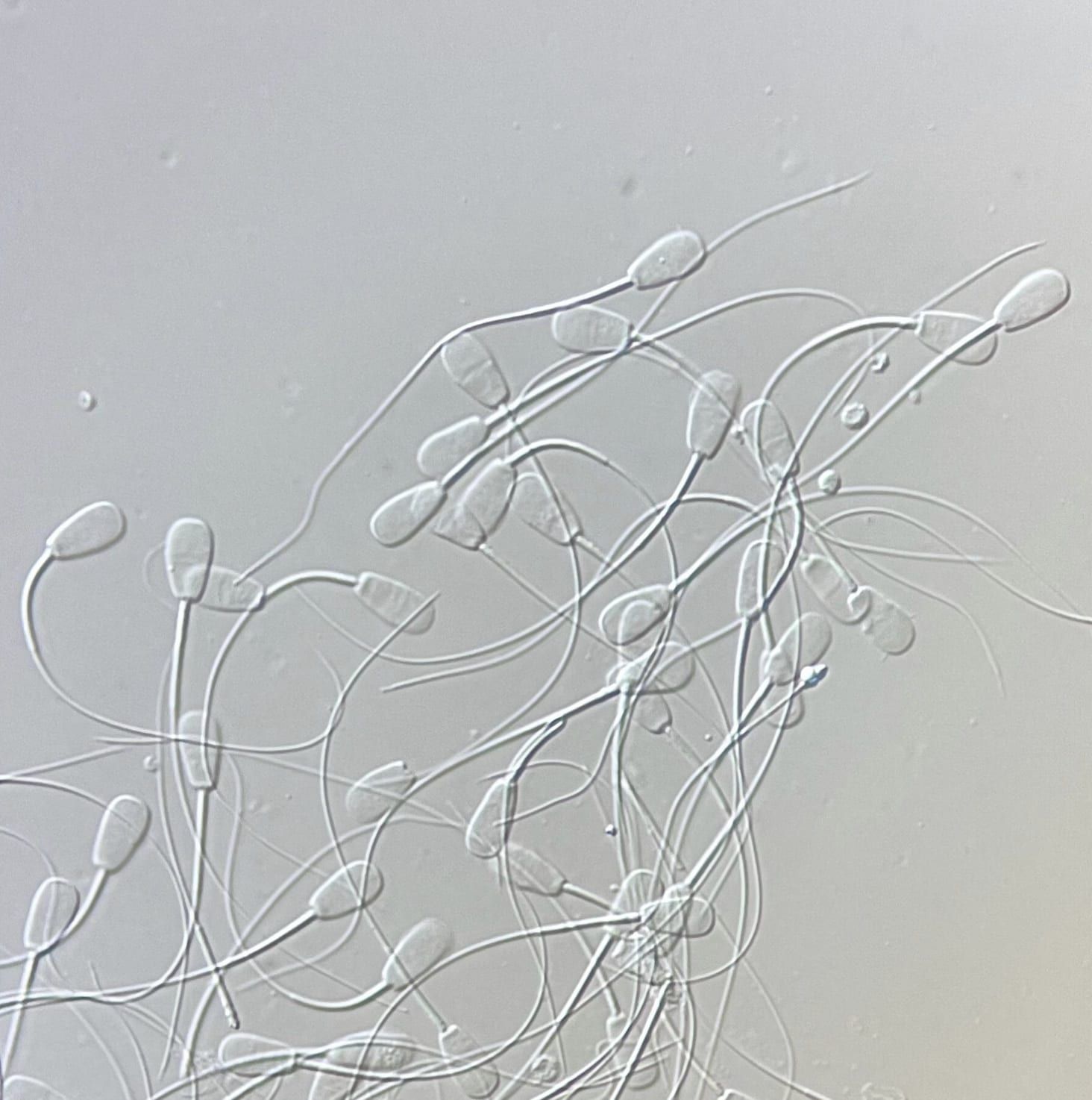 Sperm cells with oval heads and long tails, swimming in a clear liquid.