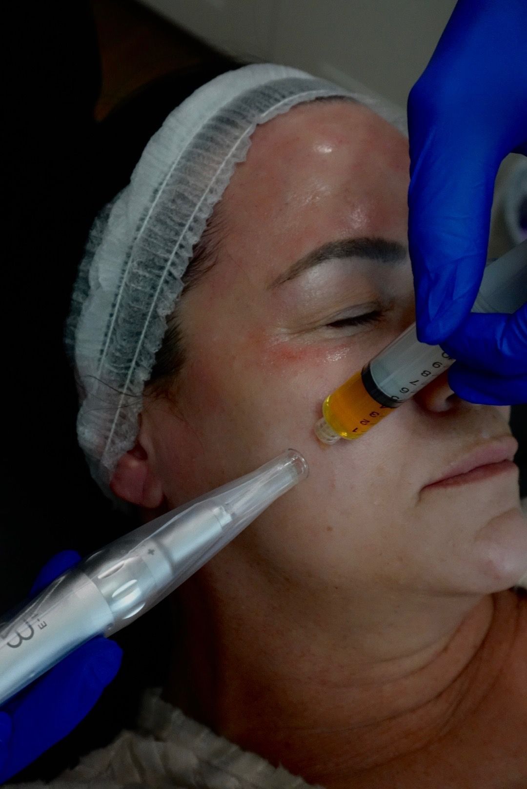 A woman is getting a microneedling with PRP facial treatment at a medspa