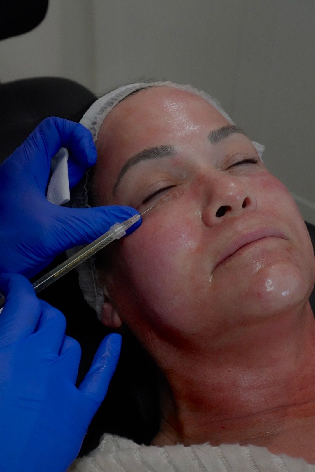 A woman is getting a microneedling treatment