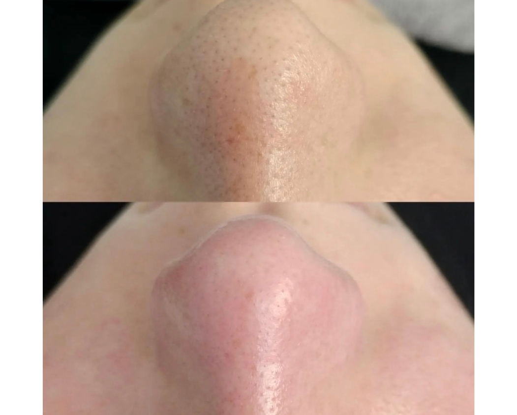 Ein Vorher-Nachher-Bild der Nase einer Person.