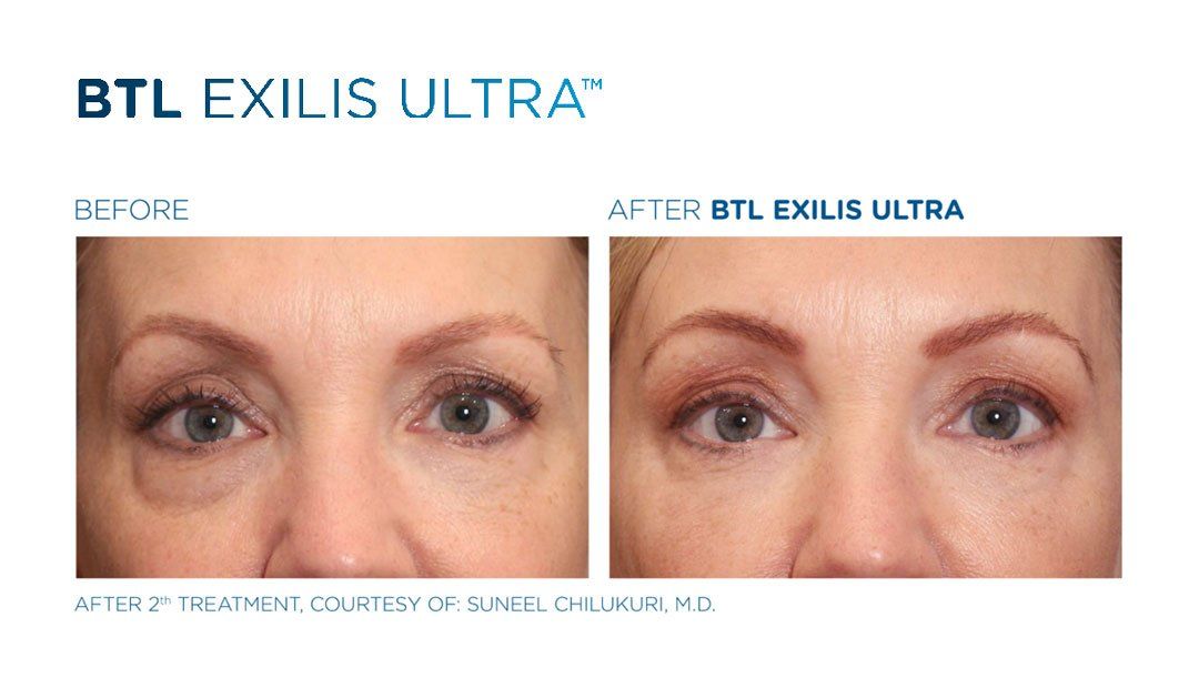 Eyebag Treatment — Westerville, OH — Dr. Mantor's Wrinkle and Weight Solutions LLC