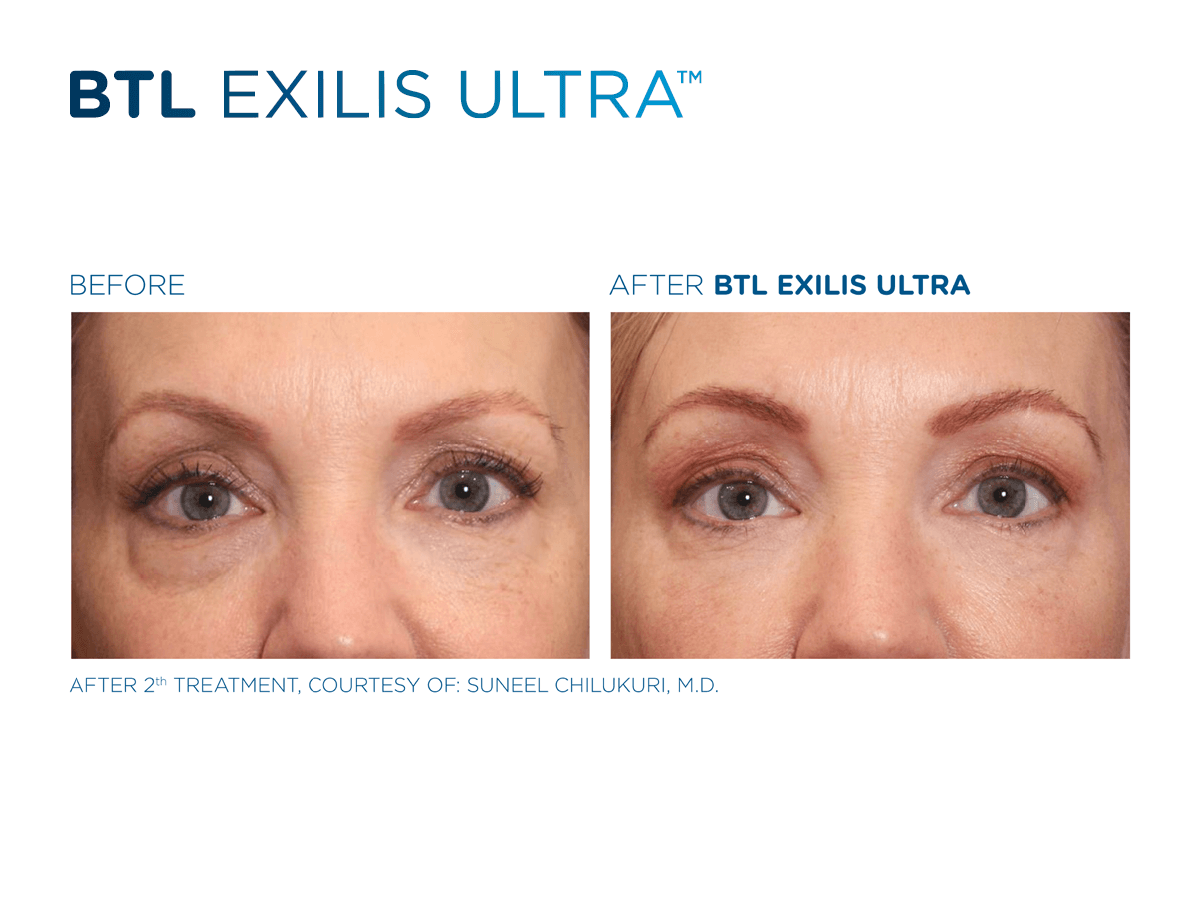 exilis