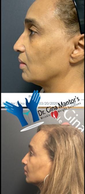 Side View Before and After Lift - Westerville, OH - Dr. Mantor's Wrinkle and Weight Solutions LLC