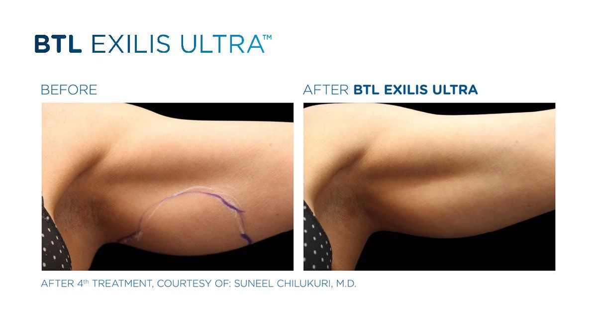 Arm Treatment — Westerville, OH — Dr. Mantor's Wrinkle and Weight Solutions LLC