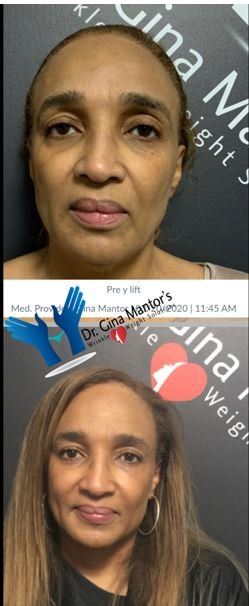 Woman Before And After Lift Procedure - Westerville, OH - Dr. Mantor's Wrinkle and Weight Solutions LLC