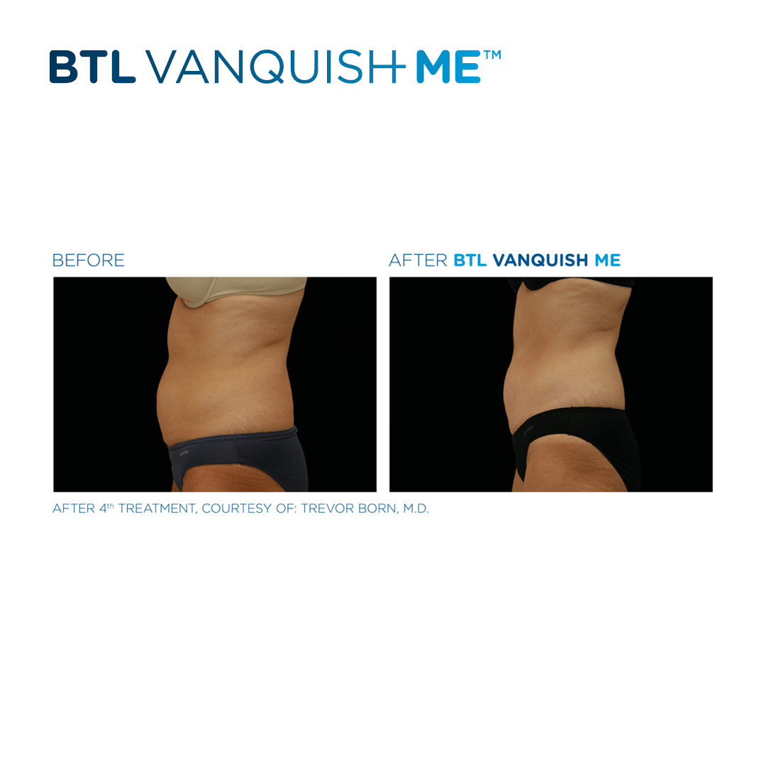 Vanquish ME results on abs at Dr. Mantor's Wrinkle and Weight Solutions in Westerville, OH