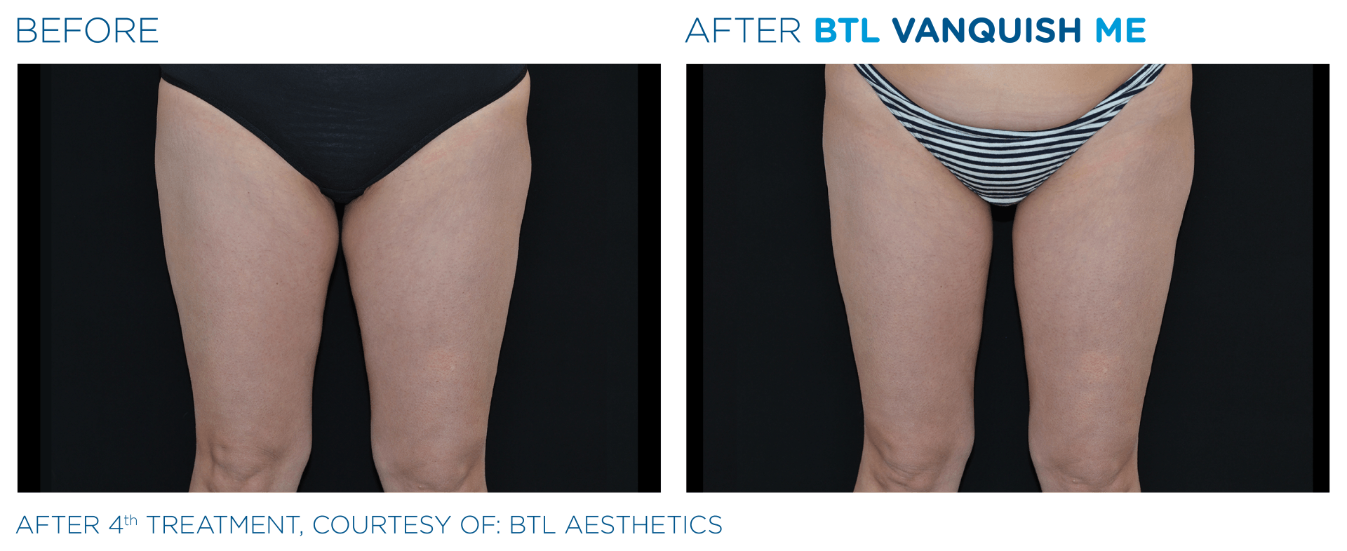 Vanquish ME results on cellulite at Dr. Mantor's Wrinkle and Weight Solutions in Westerville, OH