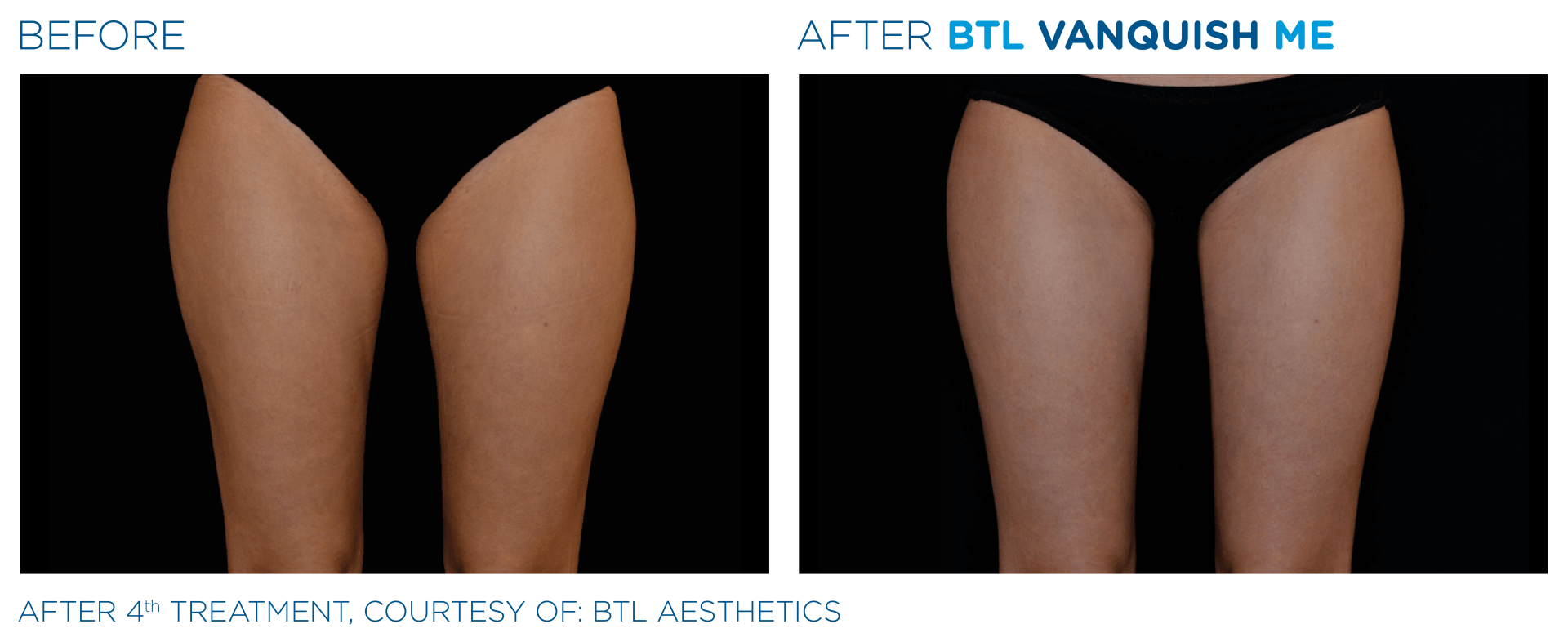 Vanquish ME results on thighs at Dr. Mantor's Wrinkle and Weight Solutions in Westerville, OH