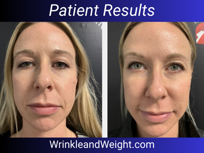Before and after Y-Lift results by Dr. Gina Mantor, Double Board-Certified Physician in Westerville, OH. This non-surgical facelift restored under-eye volume, refined the jawline, and softened nasolabial folds with instant, natural-looking lift.