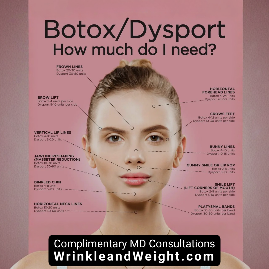 graphic showing typical units needed per area of face for Botox and Dysport
