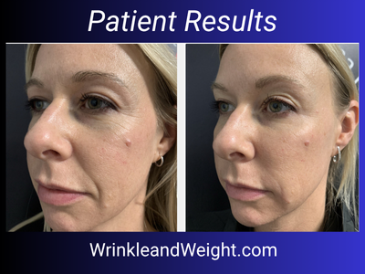 Beautiful, natural Y-Lift results by Dr. Gina Mantor — restoring youthful structure and balance to the face. Non-surgical rejuvenation for under eyes, cheeks, and jawline. Available at Wrinkle & Weight Solutions, serving Columbus and Central Ohio.