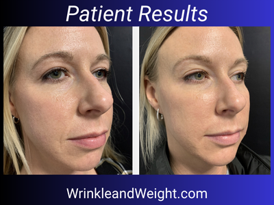 Transform with the Y LIFT®: Youthful Results in 30 Minutes by Dr. Gina Mantor