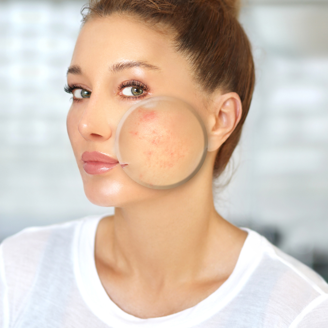 Get wrinkle-free skin in Westerville! Offering micro-needling since 2008 with free consultations.