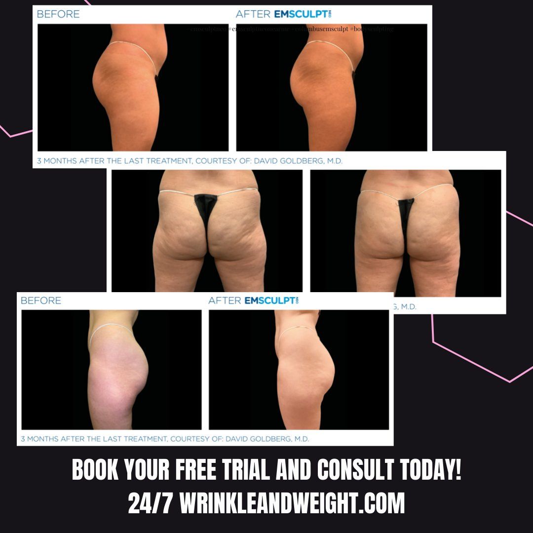 Female glute results with Emsculpt neo at Dr. Mantor's Wrinkle and Weight Solutions in Westerville, OH book your free trial today! Tighter glutes