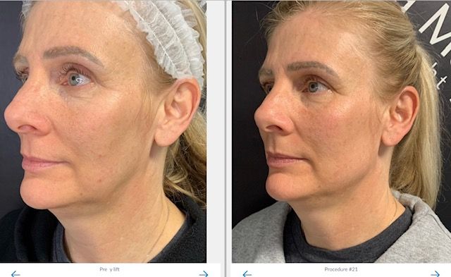 y-lift completed by Dr. Gina Mantor - anti aging - hollowness under the eyes