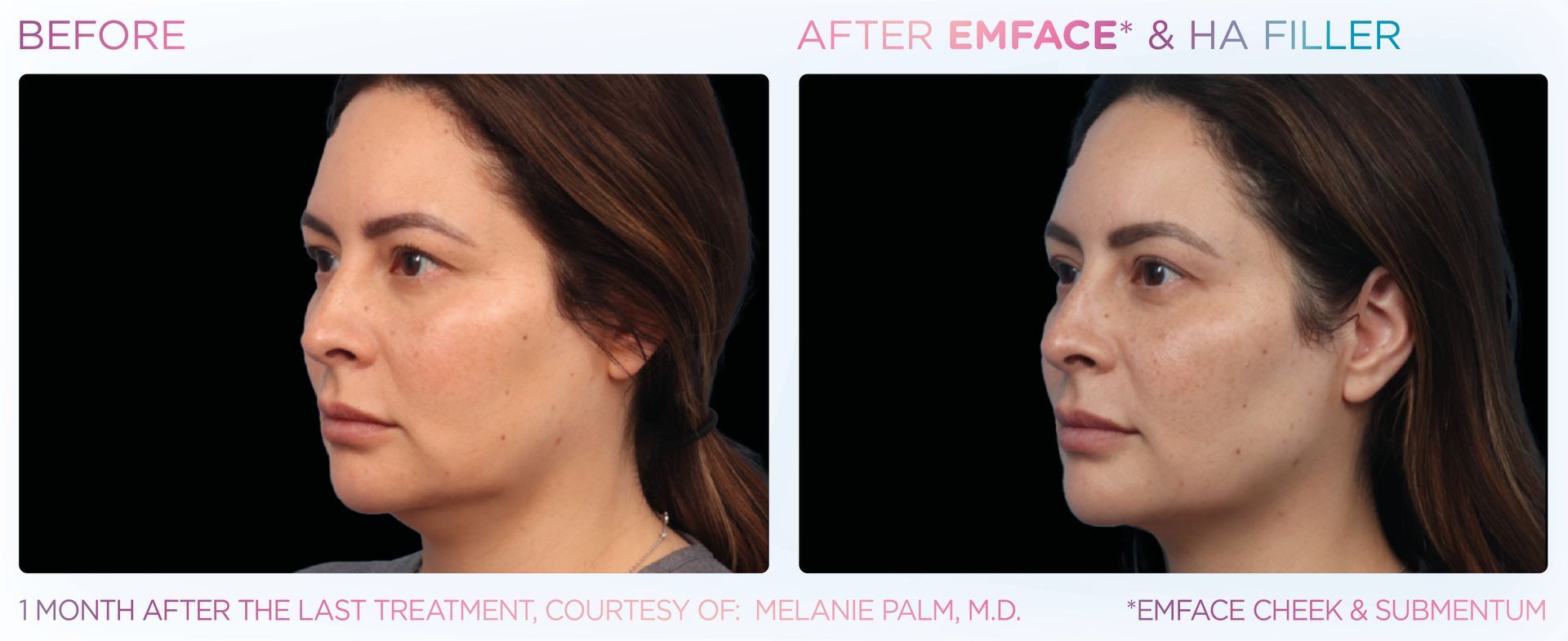 EMFACe for the double chin. No needles. No down time.