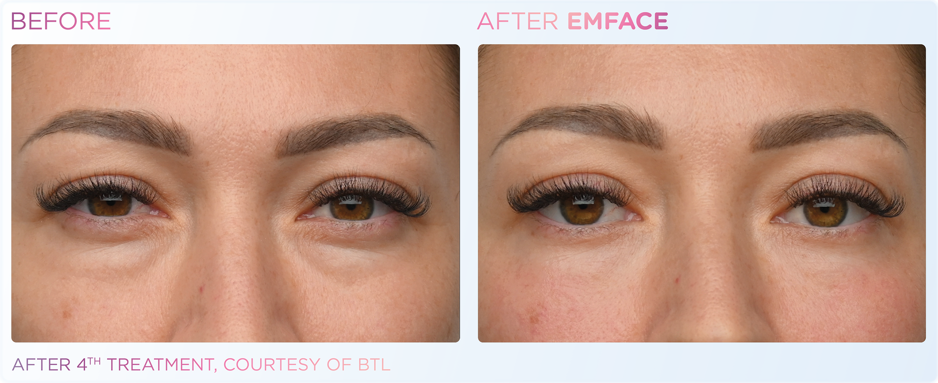 Say goodbye to crow's feet and eye bags with Emface, now at Dr. Mantor's trusted medical spa.