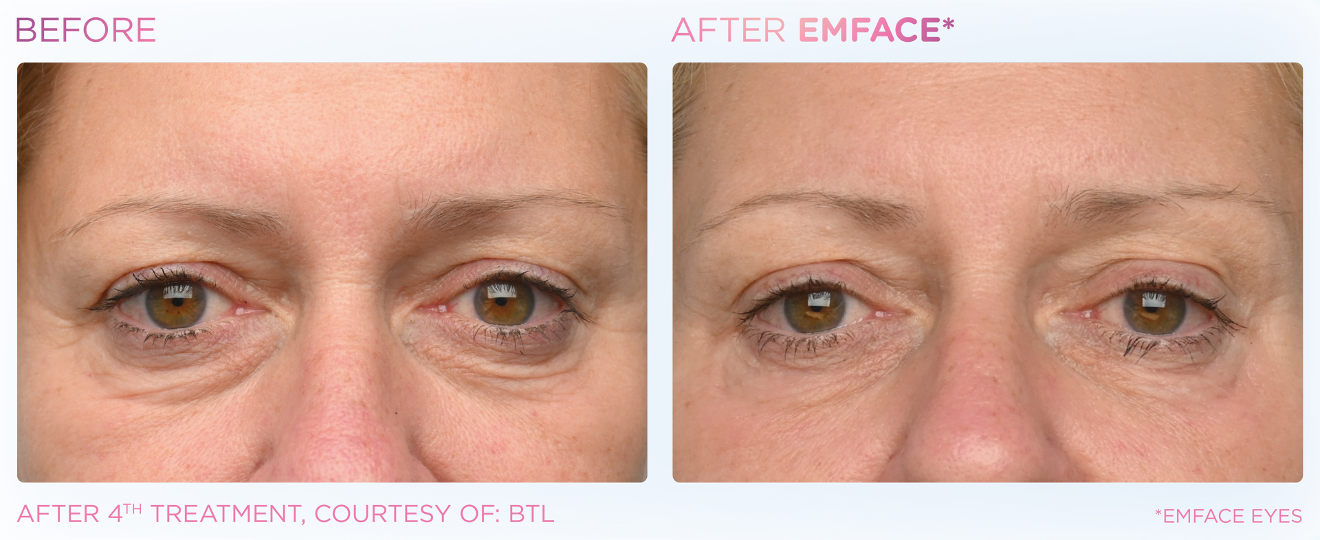 Discover Emface, a needle-free solution to eye bags and dark circles at Dr. Mantor's renowned spa.