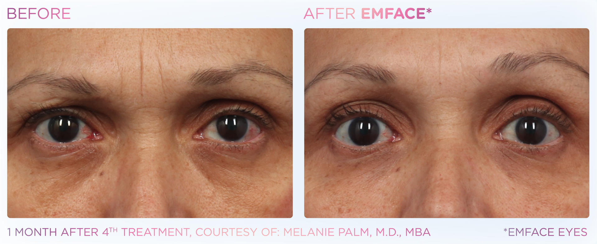 Experience Emface at Dr. Mantor's Spa. Non-needle treatment for dark circles, eye bags, and crows feet.
