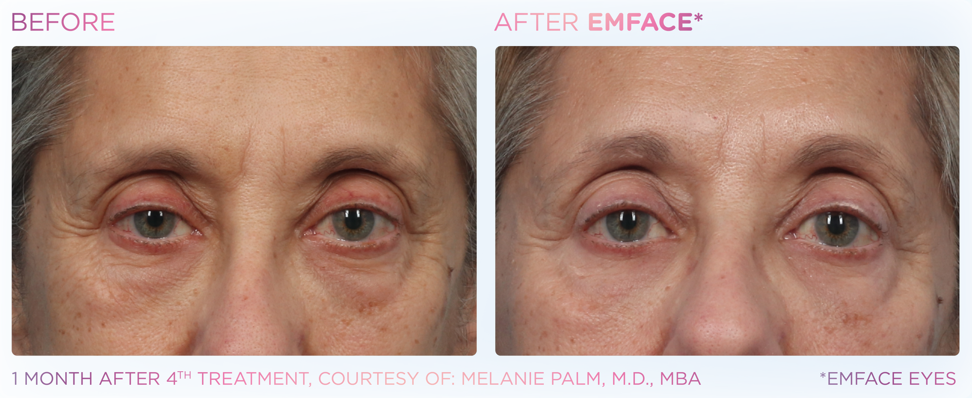 Experience Emface at Dr. Mantor's Spa. Non-needle treatment for dark circles, eye bags, and crows feet.