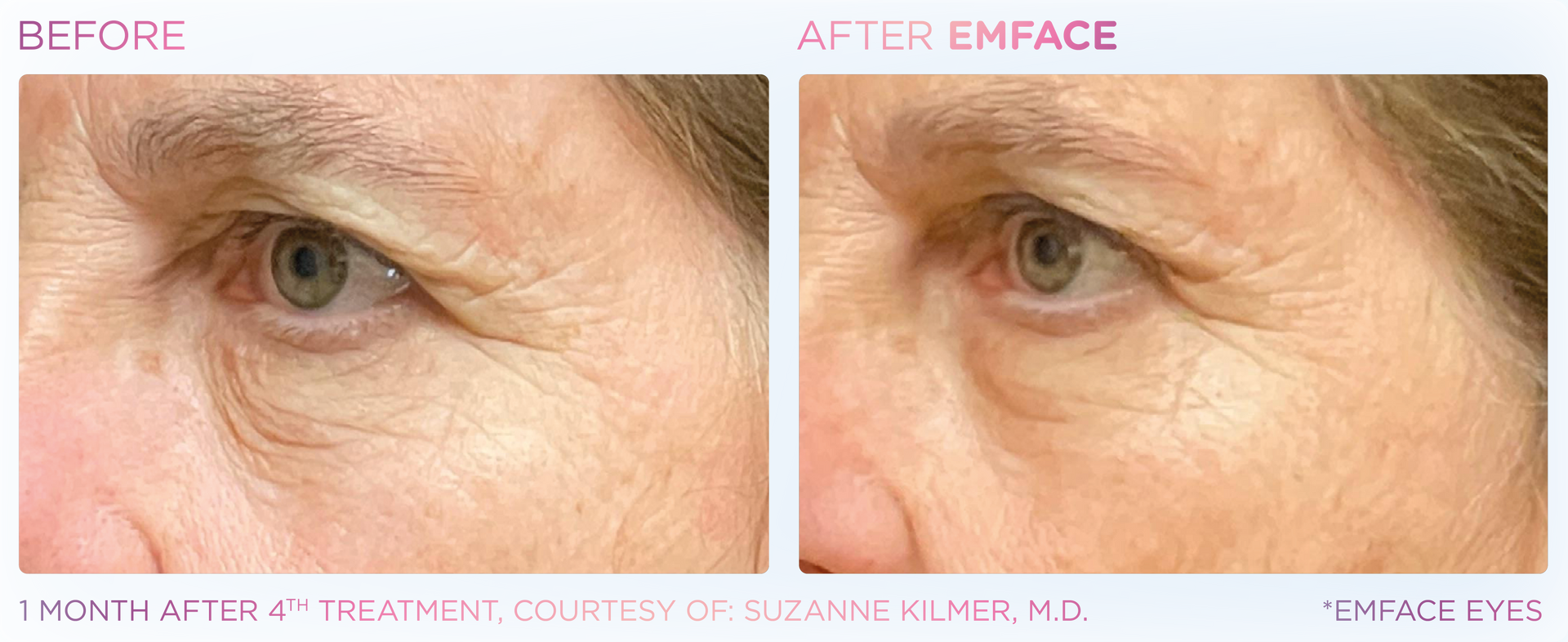 Emface treatment now at Dr. Mantor's Spa. No injections or needles. Banish eye bags and dark circles.