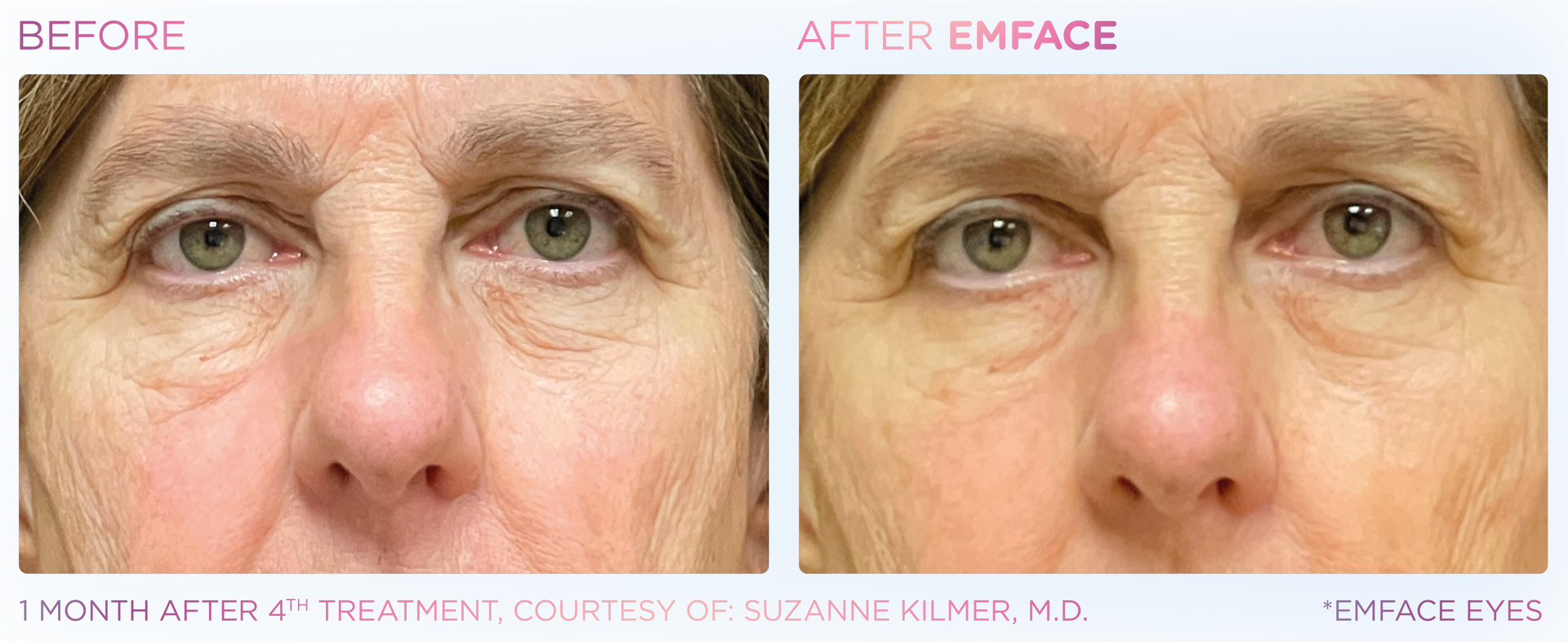 Experience Emface at Dr. Mantor's Spa. Non-needle treatment for dark circles, eye bags, and crows feet.