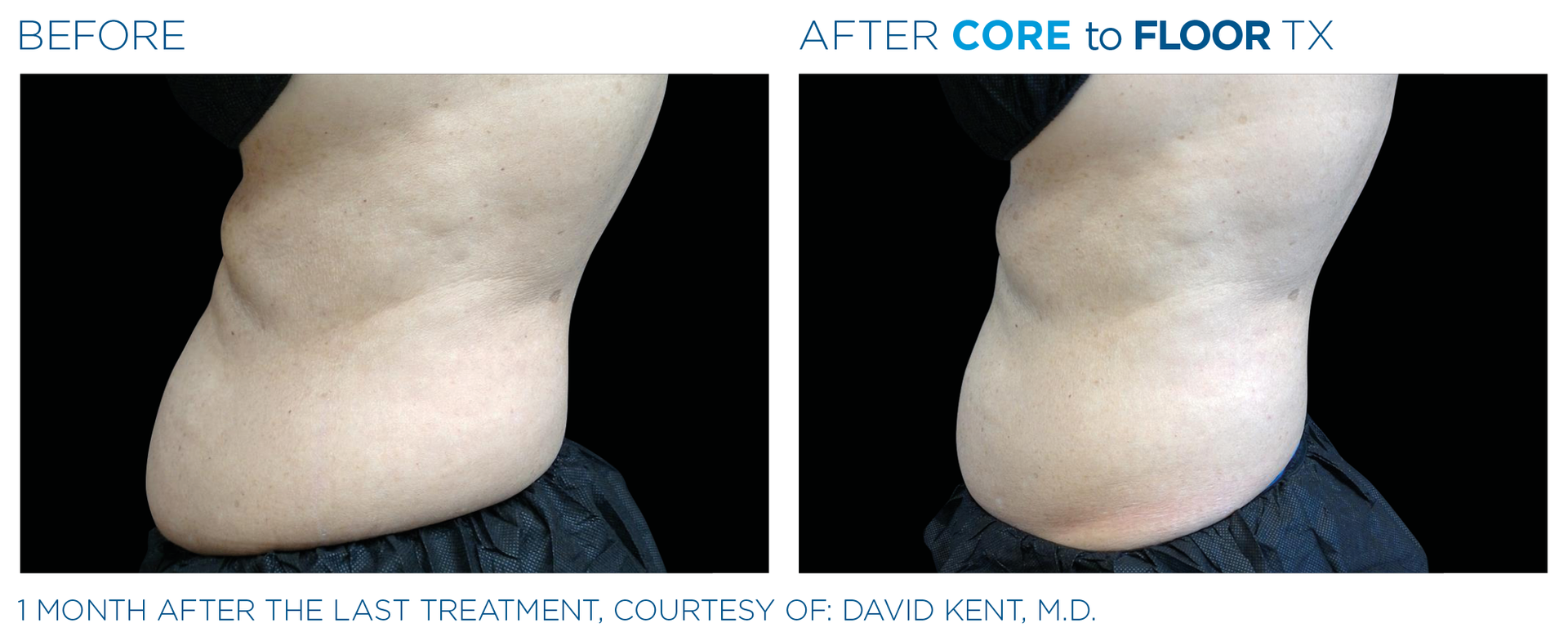 Male ab results with Emsculpt neo at Dr. Mantor's Wrinkle and Weight Solutions in Westerville, OH book your free trial today!