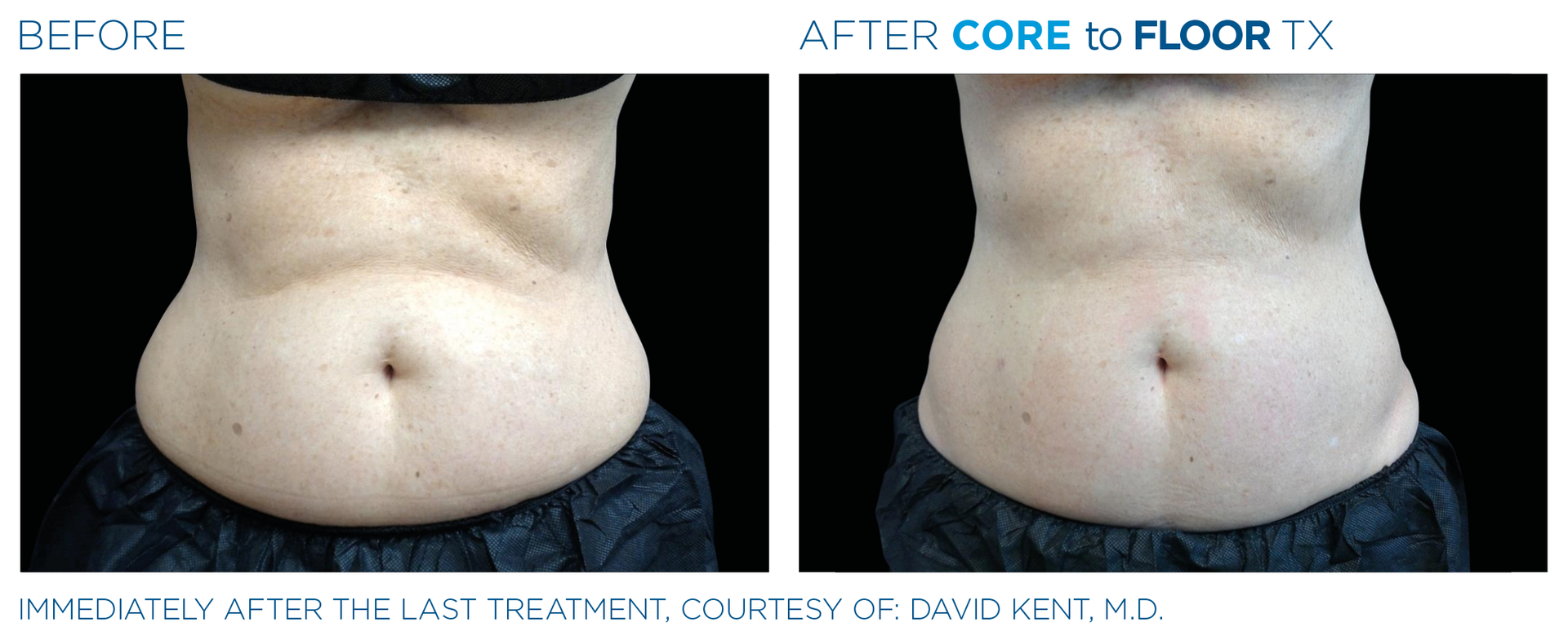 Results with Emsculpt neo at Dr. Mantor's Wrinkle and Weight Solutions in Westerville, OH book your free trial today!