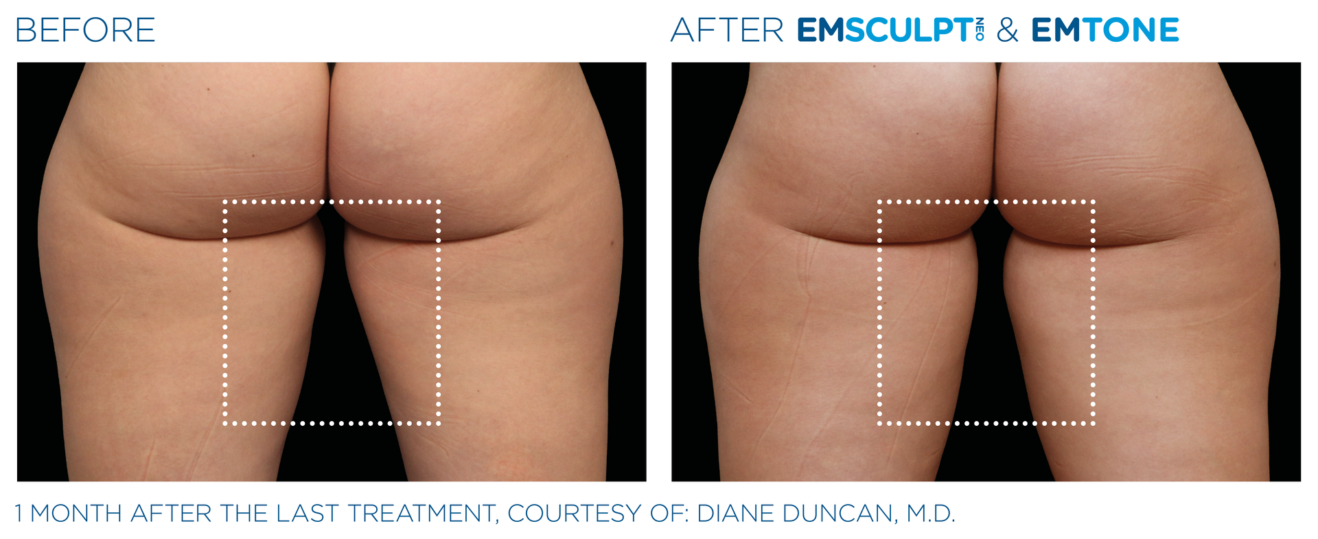 Female glute results with Emsculpt neo at Dr. Mantor's Wrinkle and Weight Solutions in Westerville, OH book your free trial today!