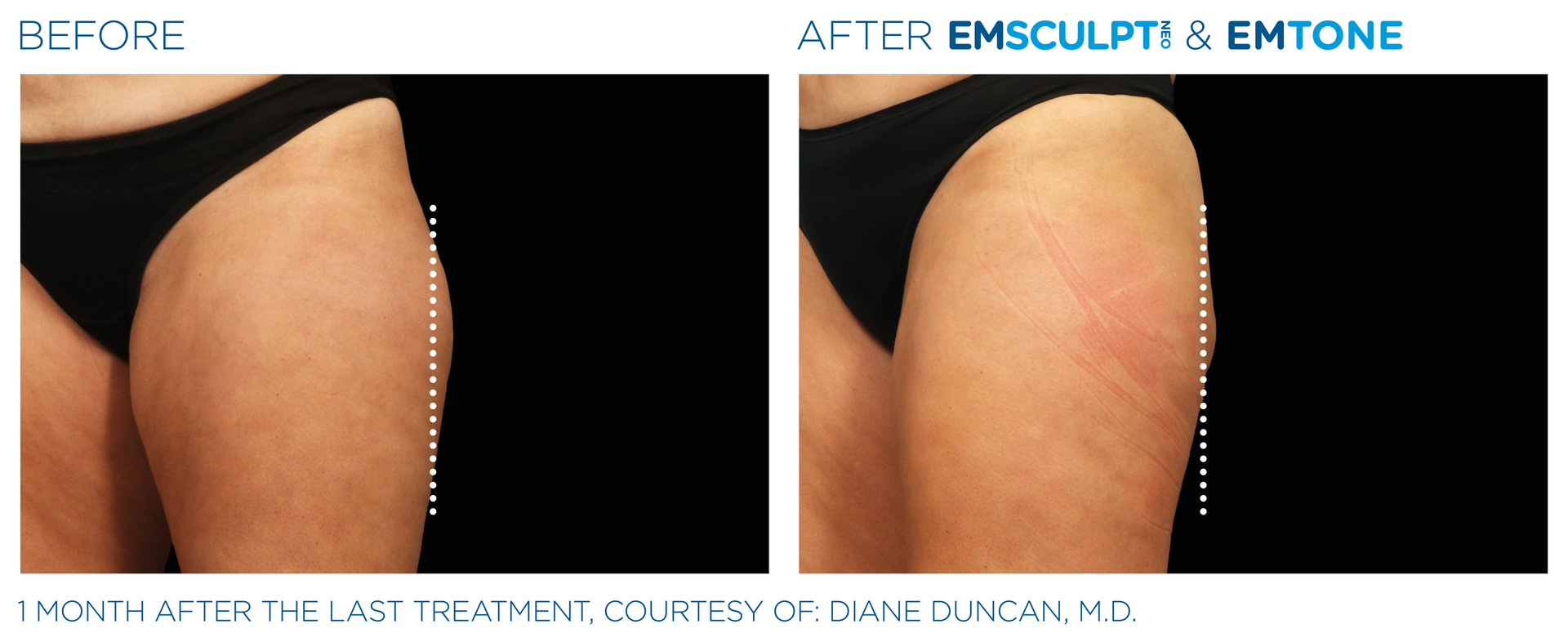Saddle bag esults with Emsculpt neo at Dr. Mantor's Wrinkle and Weight Solutions in Westerville, OH book your free trial today!