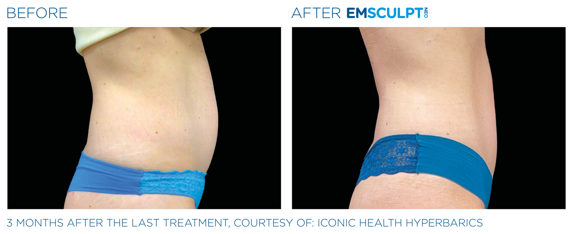 Burn fat build muscle with  Emsculpt neo at Dr. Mantor's Wrinkle and Weight Solutions in Westerville, OH book your free trial today!