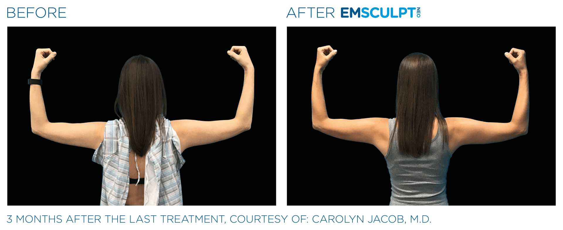 Female arm results with Emsculpt neo at Dr. Mantor's Wrinkle and Weight Solutions in Westerville, OH book your free trial today!