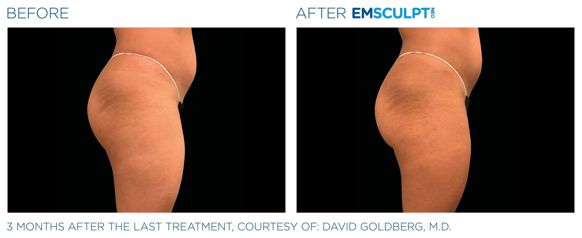 Check out those glute esults with Emsculpt neo at Dr. Mantor's Wrinkle and Weight Solutions in Westerville, OH book your free trial today!