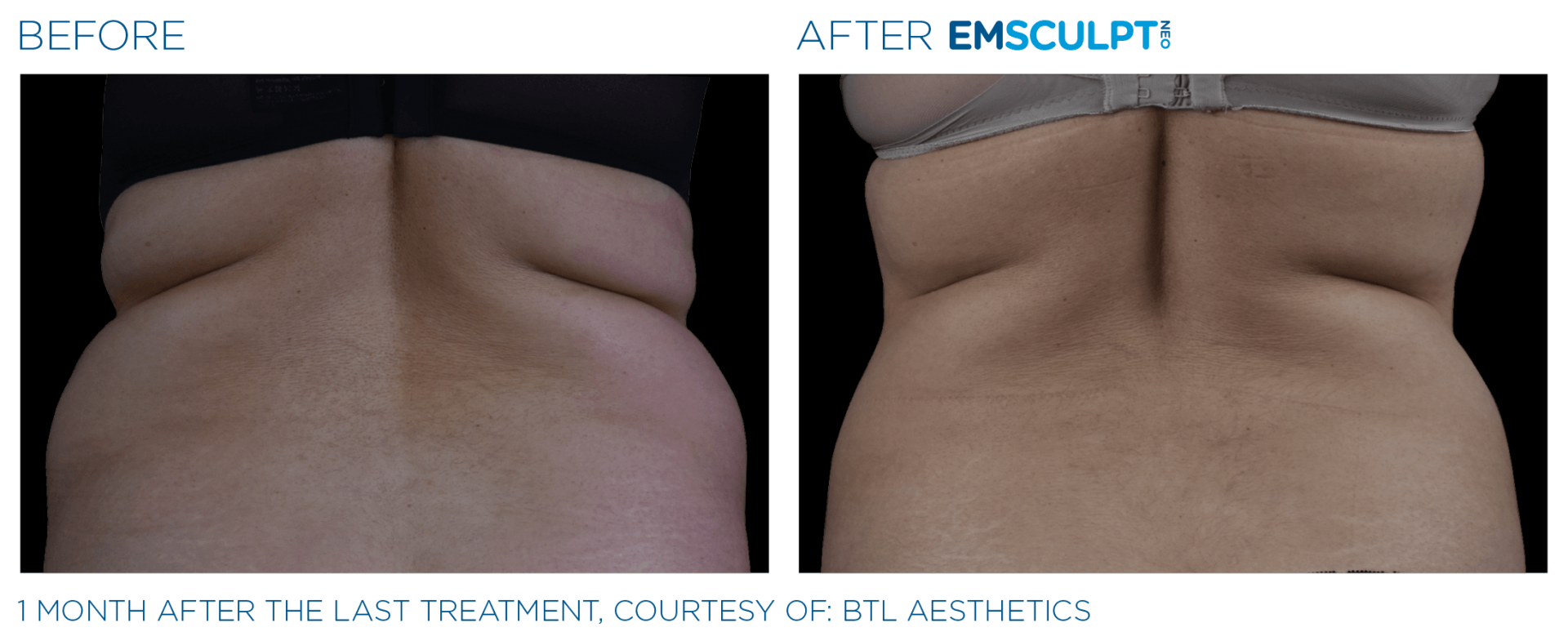 Bra roll results with Emsculpt neo at Dr. Mantor's Wrinkle and Weight Solutions in Westerville, OH book your free trial today!