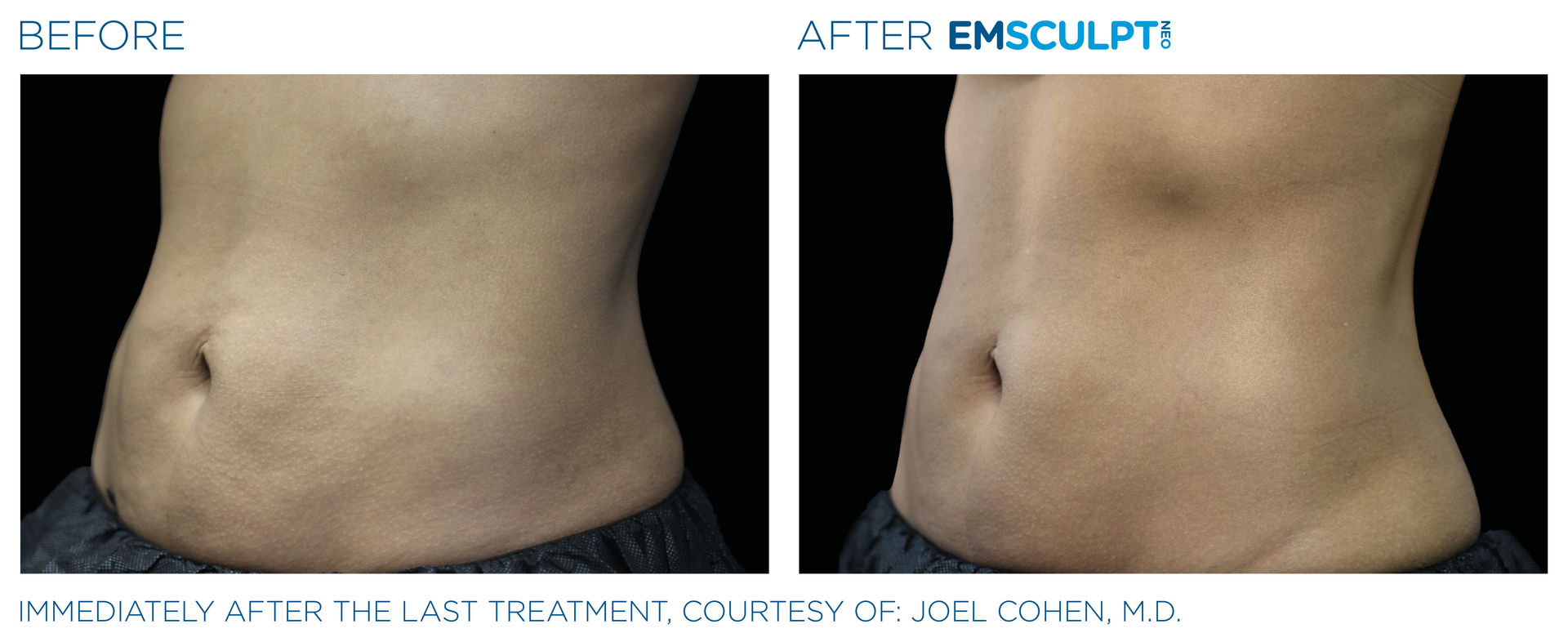 Male ab results with Emsculpt neo at Dr. Mantor's Wrinkle and Weight Solutions in Westerville, OH book your free trial today!