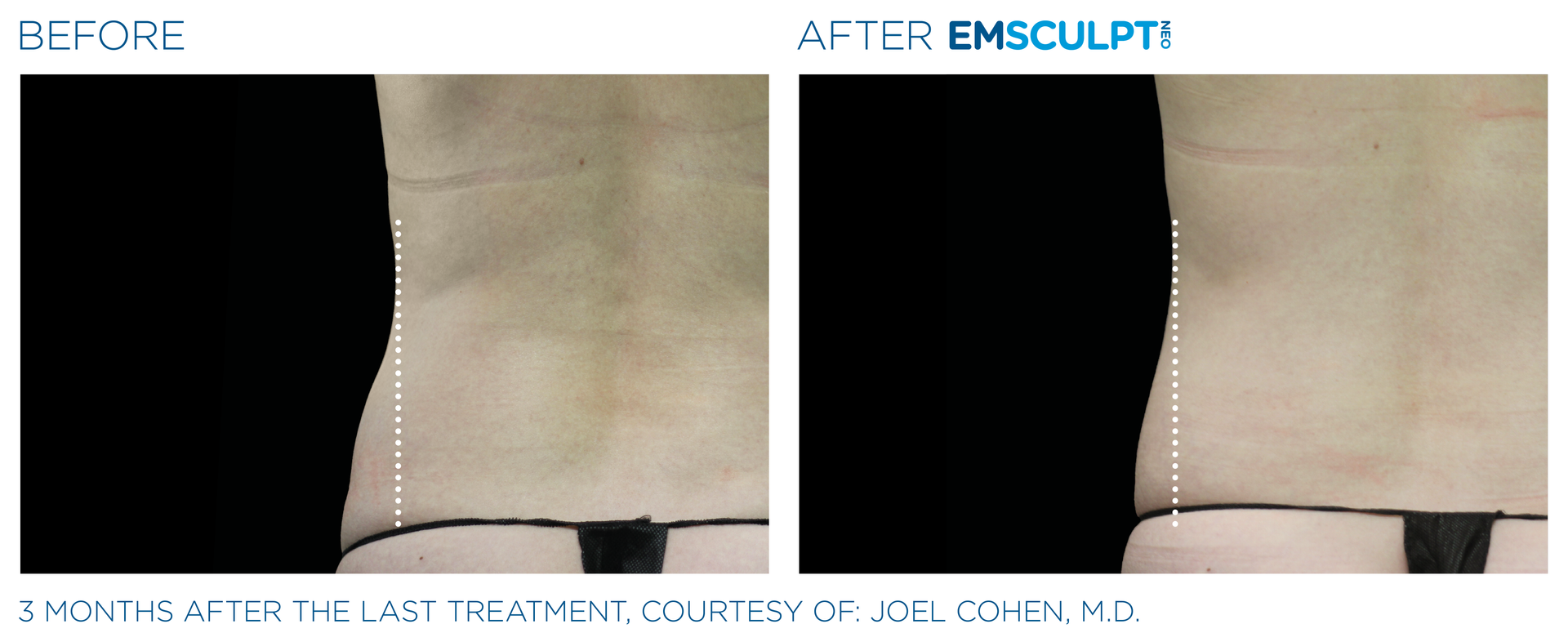Female love handle results with Emsculpt neo at Dr. Mantor's Wrinkle and Weight Solutions in Westerville, OH book your free trial today!