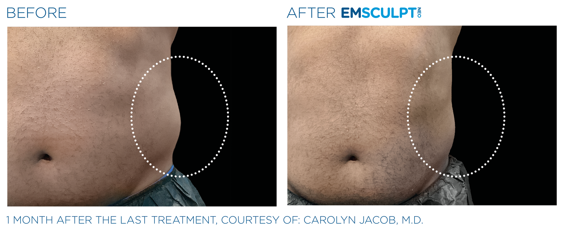 Male love handle results with Emsculpt neo at Dr. Mantor's Wrinkle and Weight Solutions in Westerville, OH book your free trial today!