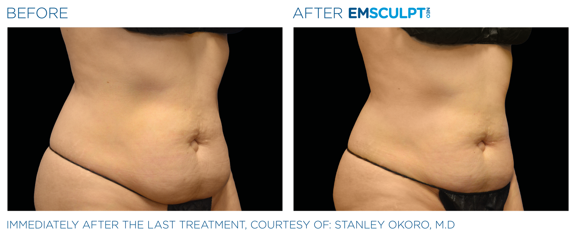 Results with Emsculpt neo at Dr. Mantor's Wrinkle and Weight Solutions in Westerville, OH book your free trial today!