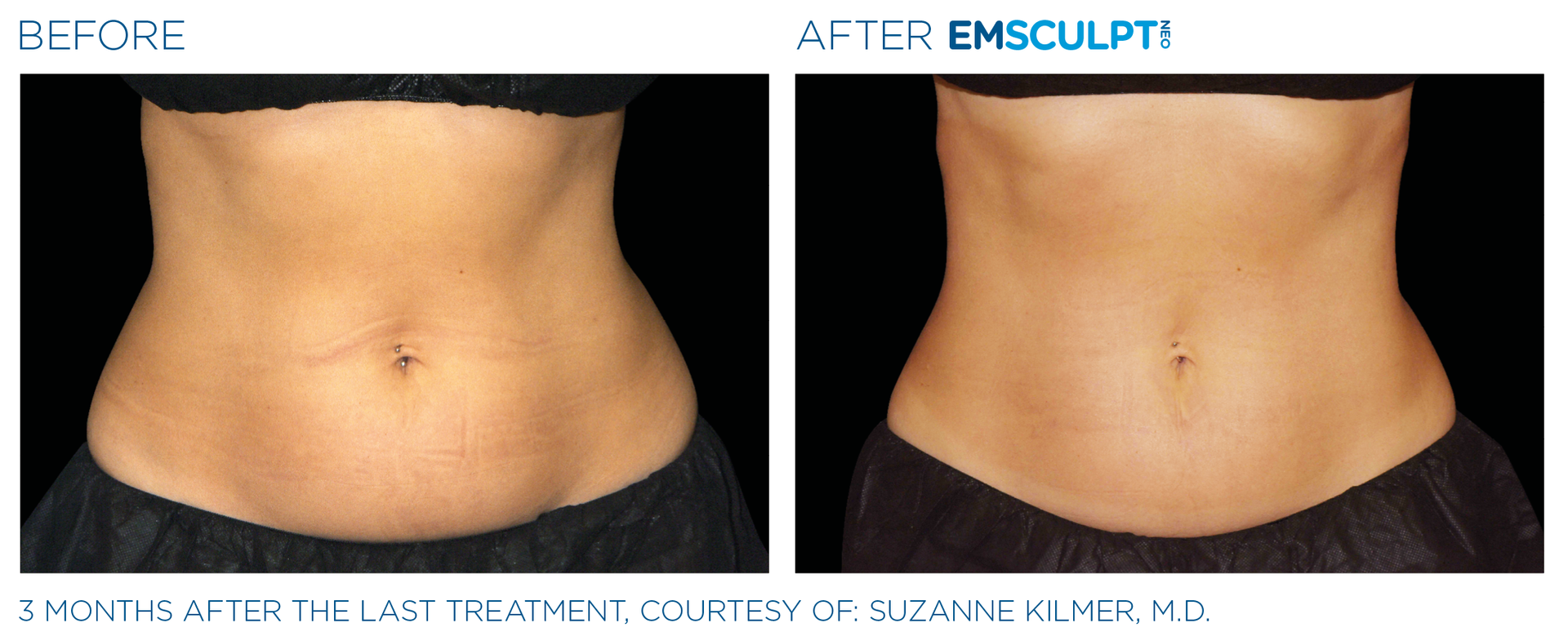 Transform your body with EmSculpt NEO's muscle toning and fat reduction at Wrinkle and Weight in Columbus.