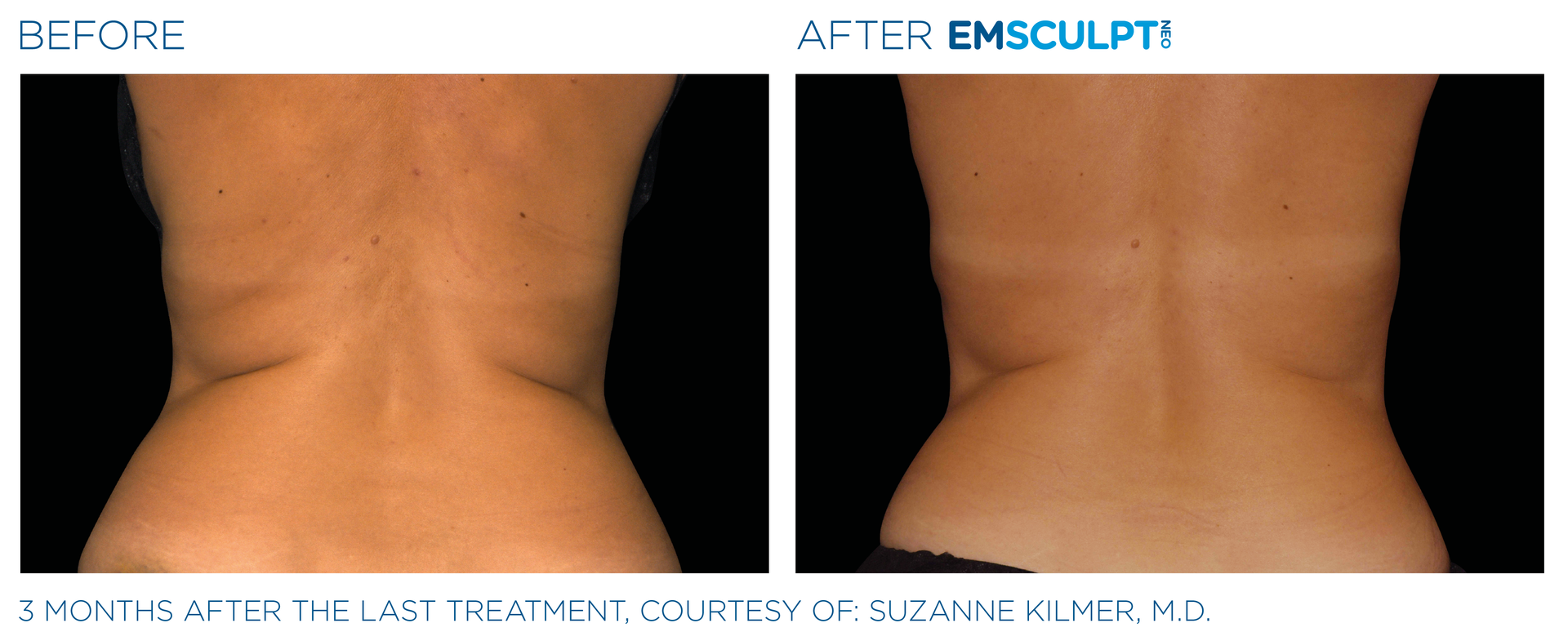 Discover non-invasive EmSculpt for targeted muscle definition and enhanced self-confidence in Central Ohio.