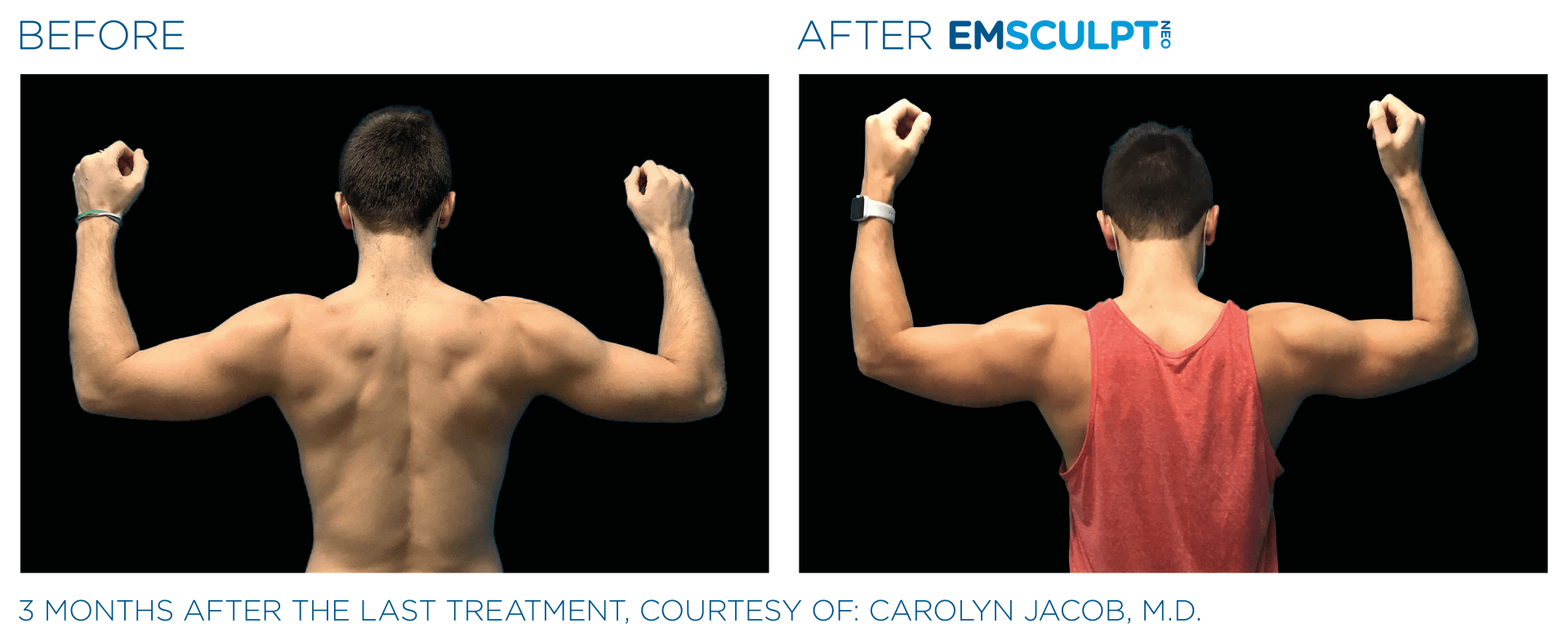 Male arm results with Emsculpt neo at Dr. Mantor's Wrinkle and Weight Solutions in Westerville, OH book your free trial today!
