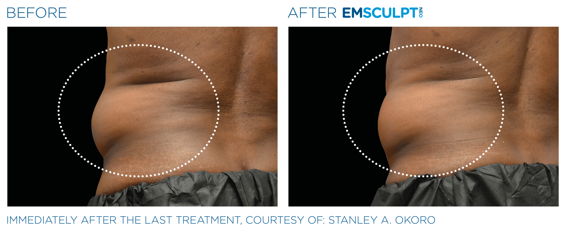 Jelly roll results with Emsculpt neo at Dr. Mantor's Wrinkle and Weight Solutions in Westerville, OH book your free trial today!